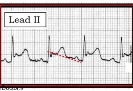 در نوار قلب نشانه های بيمارى پريكارديت
