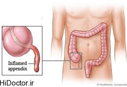 همه چیز درباره مراقبت پس از عمل آپاندیس