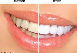 تفاوت بین روش های شفاف کردن دندان و جرم گیری آن