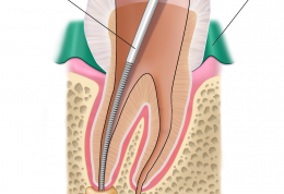 اطلاعاتی راجع به عصب کشی دندان