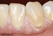 نشانه های بیماریهای بدن در دندان