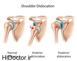 گفتگوی سوال و جوابی  در مورد دررفتگی مکرر شانه