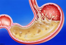 خوردنی های ممنوع برای مبتلایان به رفلاکس اسید معده