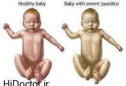 کاملترین توضیحات در مورد زردی نوزاد