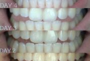 تاثیرات مفید نارگیل برای دندان