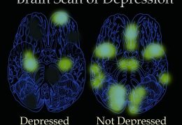 افسردگی و بروز این مشکلات در مغز