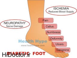 نکاتی جامع درباره درد پای دیابتی