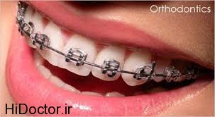 رابطه ارتودنسی دندان با پوسیدگی