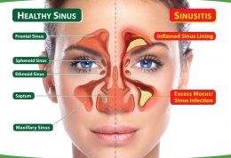از عفونت های سینوسی مزمن بترسید