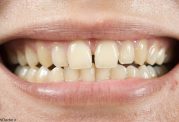 درمان و رفع عوامل موثر تغییر رنگ دندانها