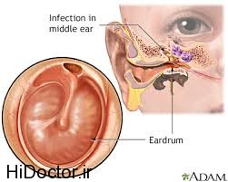 عوامل ایجاد کننده عفونت در گوش