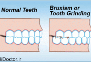 راهکارهای درمانی جالب برای دندان قروچه
