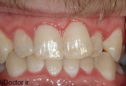 بیشترین سفیدی دندان با کمترین امکانات