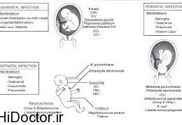 انتقال ویروس کلامیدیا از مادر به جنین