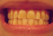 همه عادت های تهدید کننده سلامت دندان