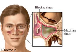 بررسی انواع عفونت سینوس قارچی و درمان هرکدام