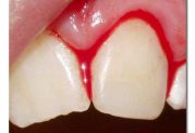 مشاهده خون دربین دندان ها پس از مسواک