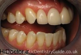 دندان پس از جرم گیری چگونه است؟