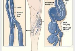 برای بیماران مبتلا به واریس این توصیه ها مهم است