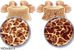 حرکاتی ورزش در استئوپروز موثر است