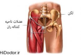 آسیب شناسی – کشیدگی عضلانی کشاله ران