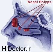 پیامدهای داشتن پولیپ در سیستم بویایی