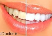 حد و مرز و خط قرمزهای شفاف کردن دندان