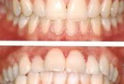 مراحل  جرم گیری دندان در محل زندگی شما