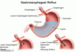 علل،علائم و درمان ریفلاکس
