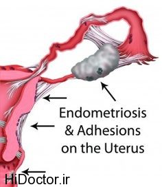 آندومتریوز و پیامدهای آن