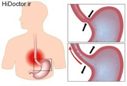 راه های مبارزه با ریفلاکس معده