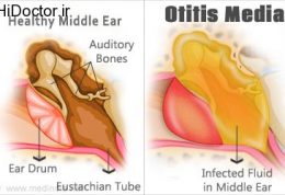 درمان نوین و کاربردی برای عفونت در سیستم شنوایی