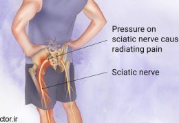 فقط با 4 ورزش از درد سیاتیک رها شوید