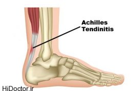 آسیب شناسی – التهاب تاندون آشیل