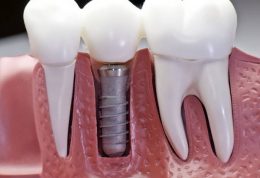 تصاویری از ایمپلنت دندان