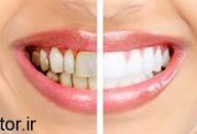 عوامل بیمار کننده دندان را بشناسید