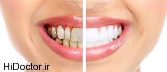 عوامل بیمار کننده دندان را بشناسید