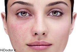 بیماری پوستی روزاسه – التهاب و قرمزی مزمن پوست صورت