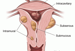 پیامدهای خطرساز فیبرم رحمی