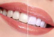 دو راه ساده برای شفافیت دندان