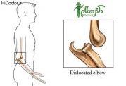 آسیب شناسی در رفتگی آرنج elbow dislocation