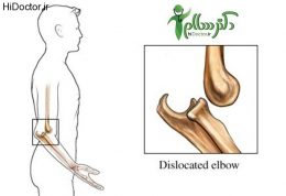 آسیب شناسی در رفتگی آرنج elbow dislocation