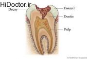 عومل منجر به پوسیدگی دندان