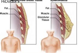 علائم و عوارض بیماری ژنیکوماستی