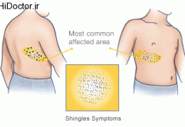 اطلاعاتی درباره ویروس shingles