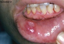 بیماری خاصی که با آفت دهان بروز می کند