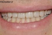 مواد طبیعی سفید کننده دندان
