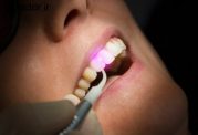 تصاویری از لیزر دندان پزشکی