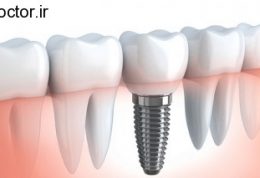 جایگزین برای ایمپلنت دندان