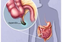 روش درمانی مفید جایگزین عمل آپاندیسیت